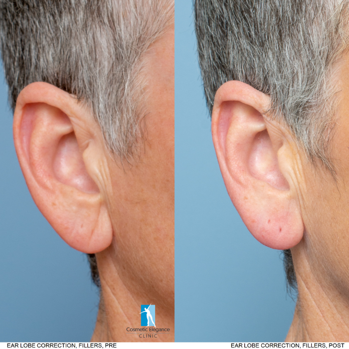 ear lobe correction Cosmetic elegance clinic